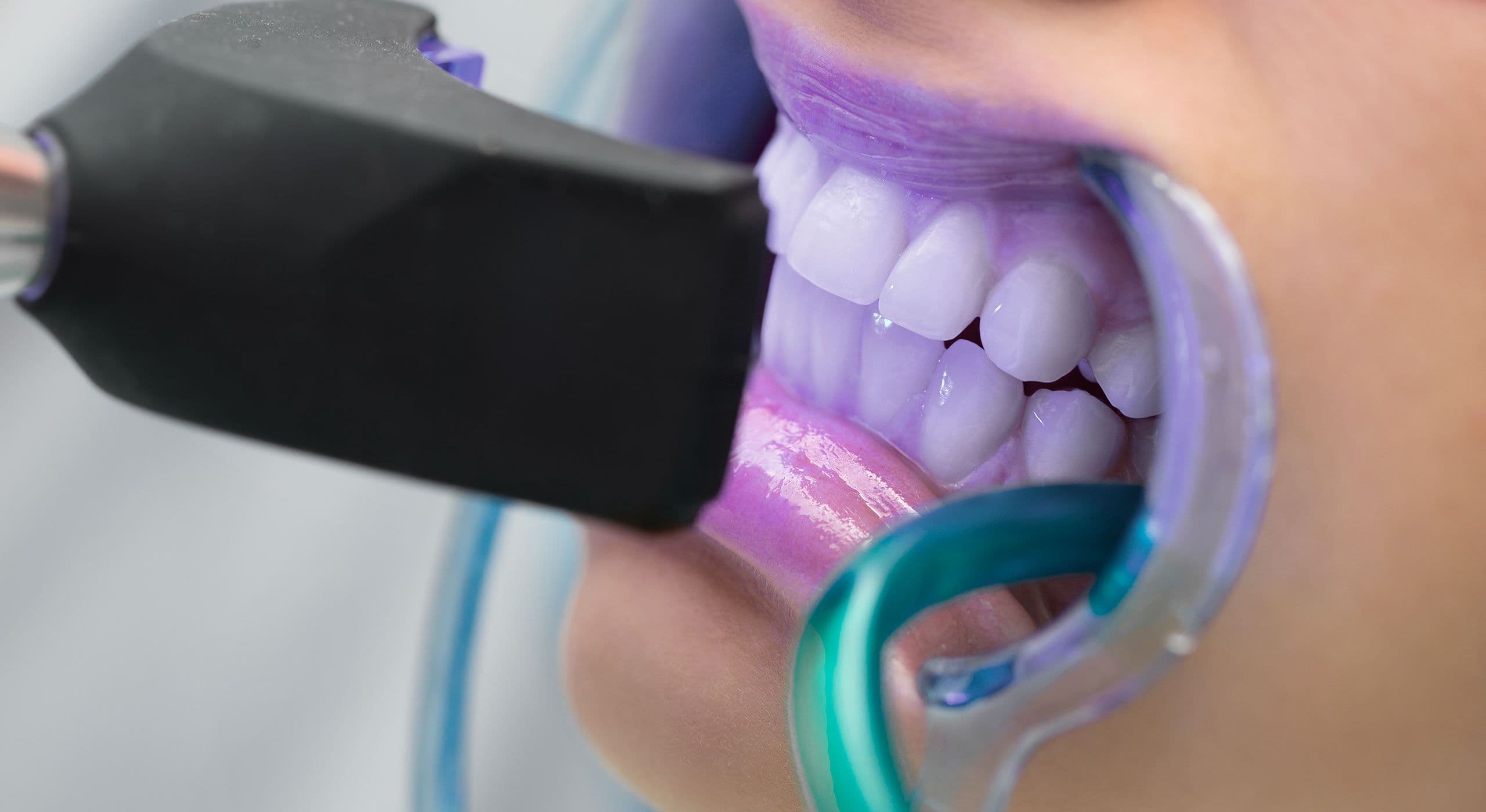 Blanchiment dentaire esthétique