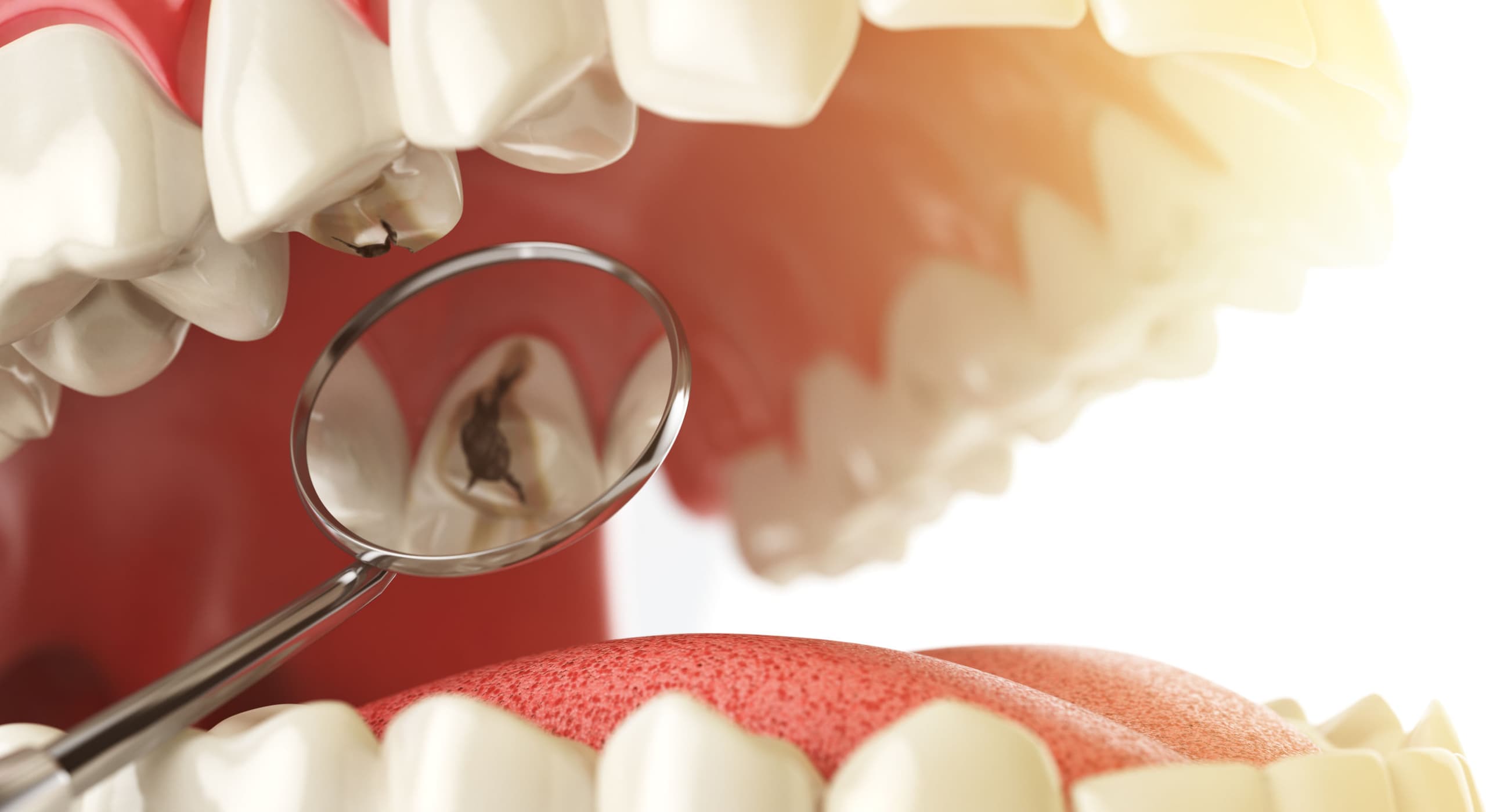 Traitement des caries