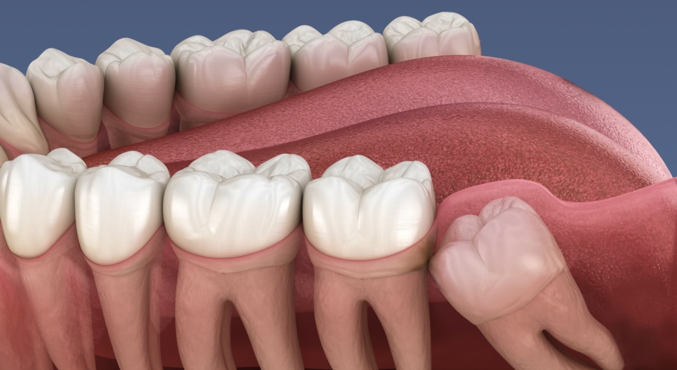Extraction des dents de sagesse