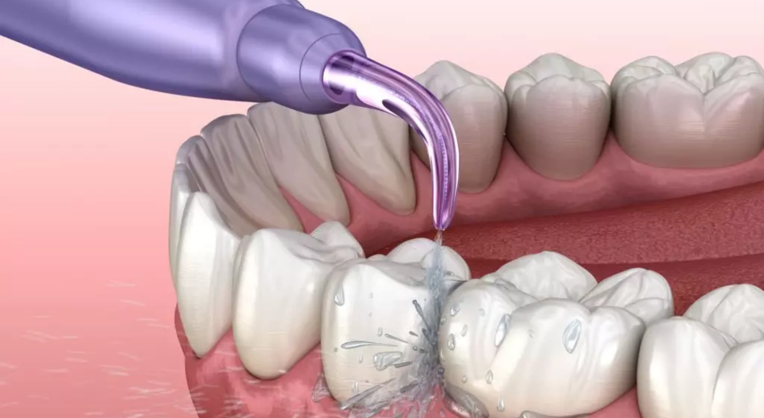 Détartrage et nettoyage professionnel